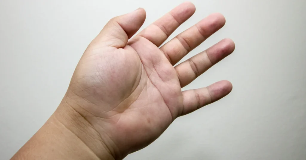 إرشادات للتخفيف من تورم اليد الصباحي