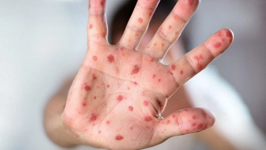 لم يعد جدري القرود حالة طوارئ عالمية