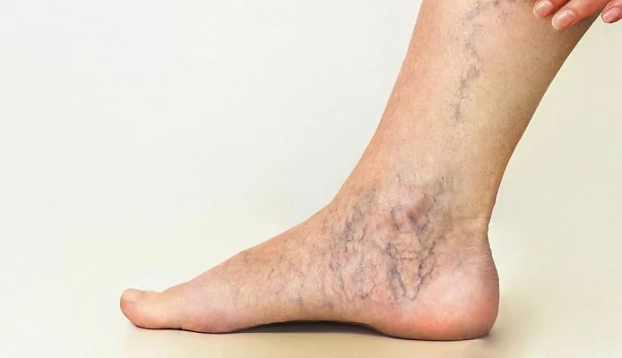 طرق منزلية فعّالة للتخفيف من دوالي الأوردة المنتفخة