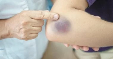 أسباب طبية لظهور كدمات على الذراعين والساقين دون إصابة — إنفوجراف