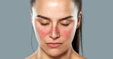 الذئبة: من أكثر الأمراض المناعية تعقيداً… طرق تشخيصها وعلاجها