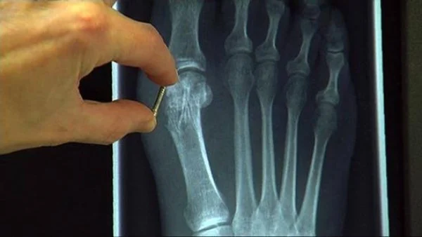 ابتكار صيني ثوري: لاصق طبي يعالج العظام المكسورة خلال 3 دقائق فقط