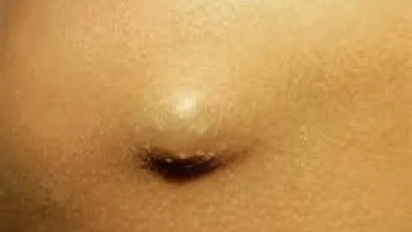 الكيس الدهني مقابل الورم: كيف تميّز بينهما؟