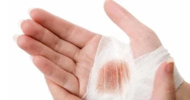 تطوير دواء جديد لعلاج التهابات الجروح المزمنة