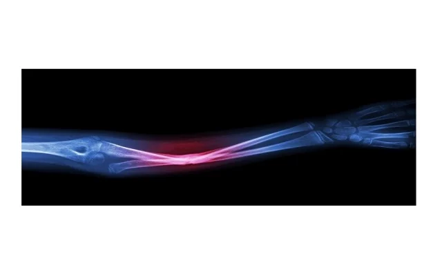 غراء ساخن لعلاج كسور العظام