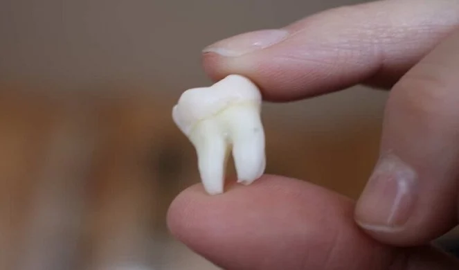 دراسة: قلع أضراس العقل قد يحسن التذوق على المدى الطويل