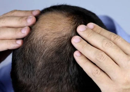 ستيفيا كمحلّي طبيعي يعزز علاج الصلع الوراثي