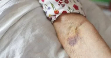 زيادة الحديد: ما هو داء ترسب الأصبغة الدموية؟ 