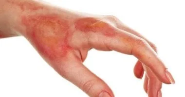 حروق الدرجة الثانية: تعرف نوعها وتعامل معها بشكل صحيح وآمن