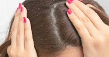 4 وصفات طبيعية تقضي على القشرة بدون تجفيف الشعر 