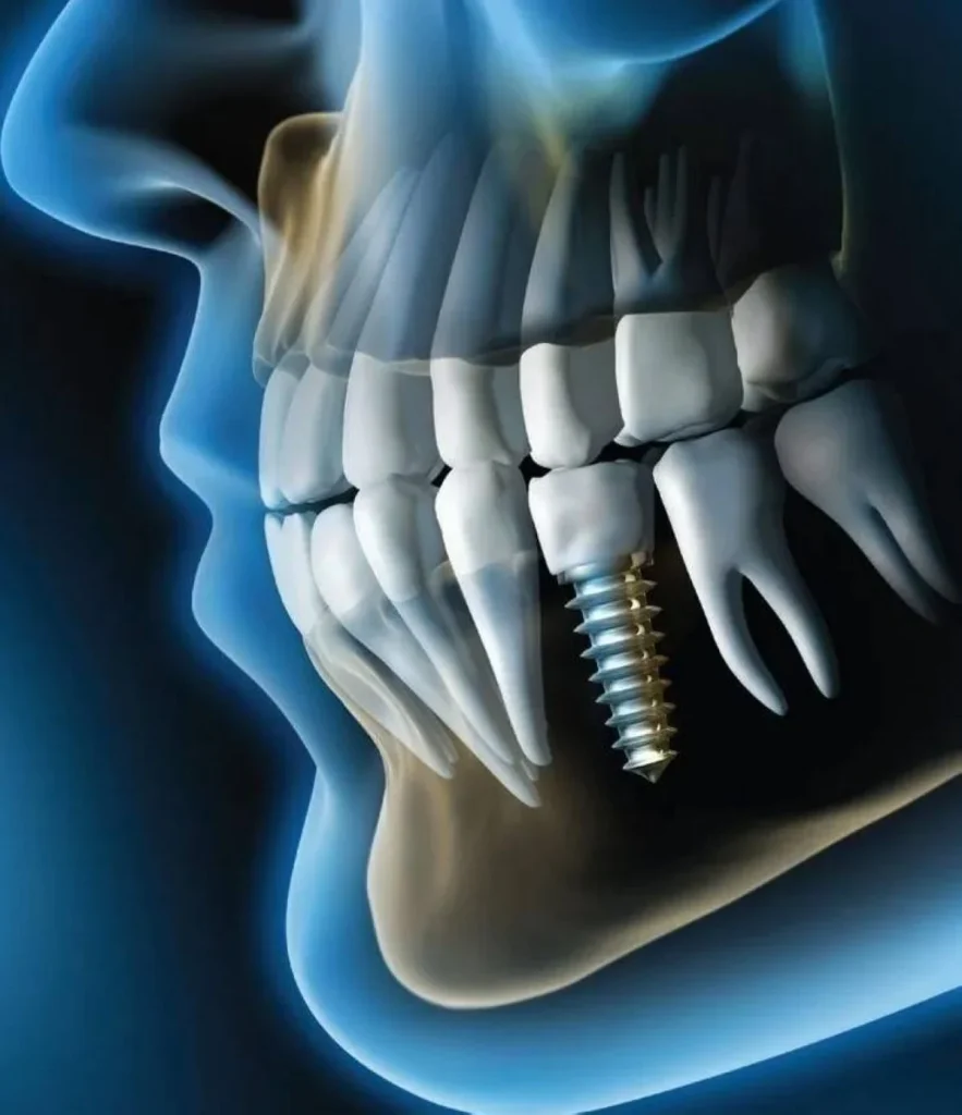 تيجان الأسنان ثلاثية الأبعاد مطبوعة بمتانة عالية وسرعة فائقة
