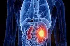 التهابات المسالك البولية تدل على سرطان الكلى