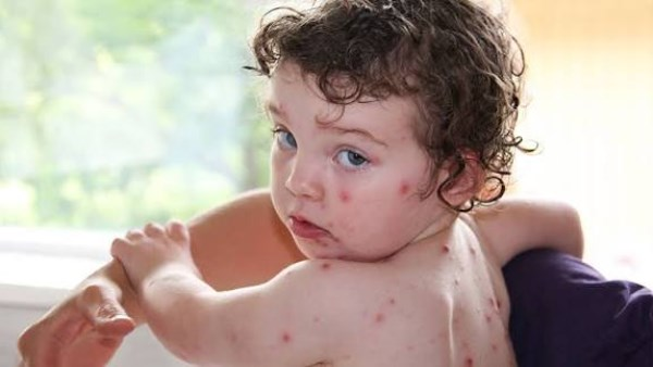 إصابة 18 طالبًا بالجدري المائي في مدرسة بالمنوفية: الأعراض والوقاية