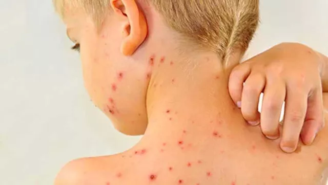 الجدرى المائى: تعريفه وأعراضه وطرق الوقاية
