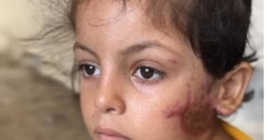 رحلة الطفلة جود ماضي للعلاج خارج غزة عقب نشر قصة إصابتها