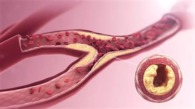 5 علامات تدل على انسداد شرايين القلب