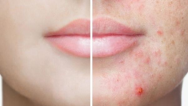لا هرمونات ولا نظافة.. تعرف على أسباب ظهور علامات حب الشباب
