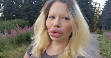 بلغارية خضعت لـ32 حقنة لتنال لقب صاحبة أكبر شفاه في العالم