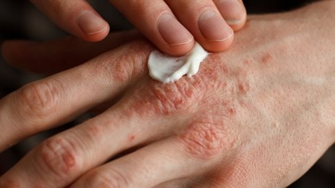 ليس مجرد مشاكل جلدية.. احذر مضاعفات الصدفية