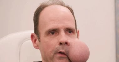 قصة رجل يعاني ورماً يزن 2 كجم في وجهه وينتظر مساعدة الأطباء