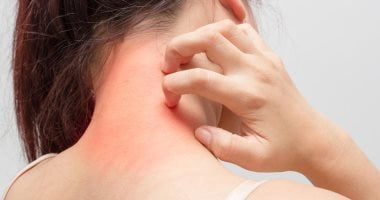 فى يومها العالمى..أفضل خيارات علاج الصدفية بأنواعها