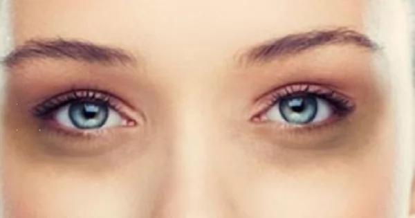ما سبب الانتفاخات والهالات السوداء تحت العين؟