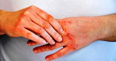 ليس فقط العوامل الوراثية.. ما سبب وعلامات الإصابة بالصدفية
