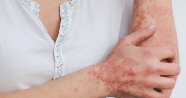 علاجات منزلية لتخفيف حدة أعراض الصدفية