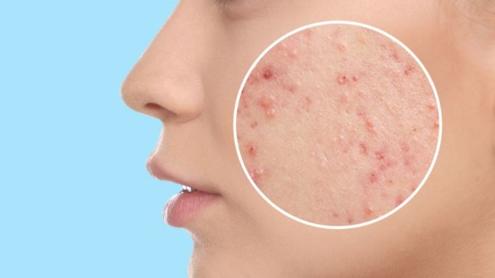 احذر من الأطعمة التي تسبب حب الشباب