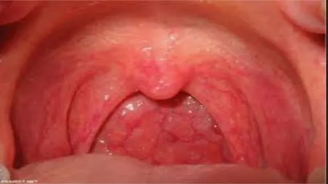 أصوات وإنذارات من جسدك: إشارات مبكرة قد تشير إلى سرطان الحلق