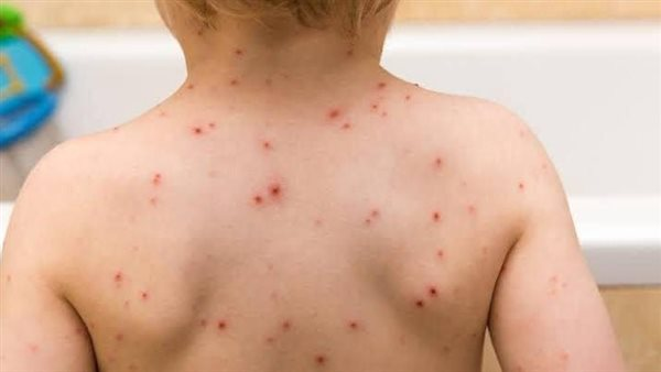 عاجل: تسجيل إصابات جديدة بمرض الجدري المائي بين طلاب المنوفية