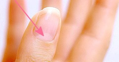 الهلال على الأظافر مؤشر لأمراض القلب والكلى