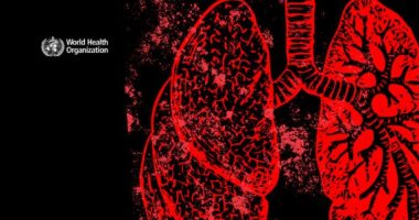 الصحة العالمية: 10.7 مليون مصاب بالسل و1.23 مليون وفيات فى 2024