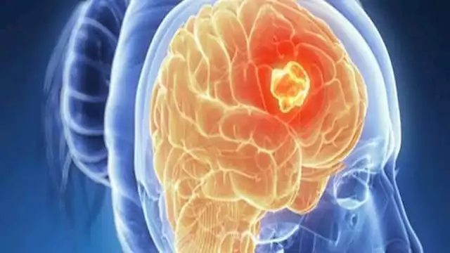 الطفلة ليلى تهزم السرطان بدعم تايلور سويفت: ما القصة؟