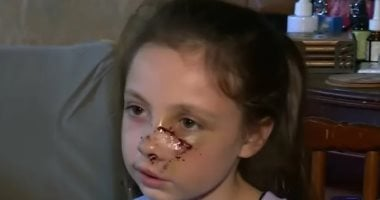 طفلة تتعرض لهجوم كلب مروع في ألاباما وإصابات خطيرة وصدمة محلية