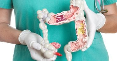 الأطعمة المعالجة من أبرز أسباب ارتفاع سرطان القولون لدى النساء