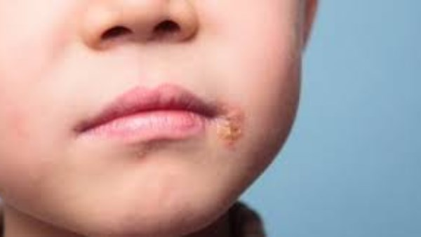 الهربس عند الأطفال: كيف تميّز أعراضه عن نزلات البرد