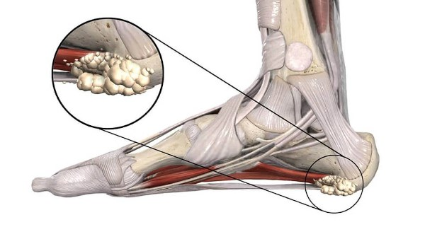 الشوكة العظمية: اكتشفها وتعامل مع ألمها