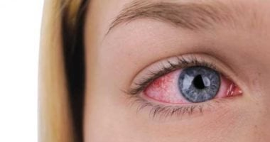 ما هي متلازمة شوجرن: علامات مبكرة