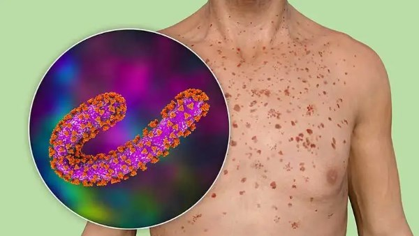 كيف تعرف أنك مصاب بفيروس ماربورج