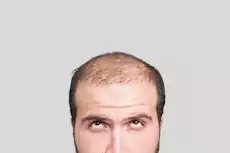 لتجنب العدوى والصلع: لا تشارك هذه الأشياء