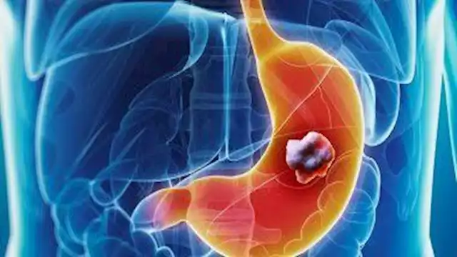 5 علامات مبكرة لسرطان القولون والمستقيم تظهر في البراز