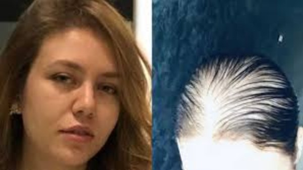 بعد أزمة صلع رحمة حسن: أفضل الزيوت الطبيعية لإعادة إنبات الشعر