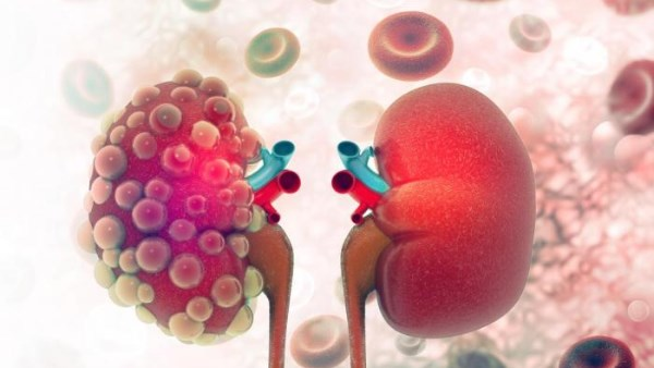 طرق الوقاية من أمراض الكلى وتجنب المسكنات