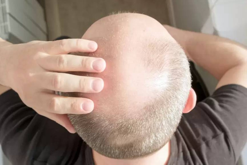 دواء جديد لعلاج الصلع الوراثي يظهر نتائج إيجابية