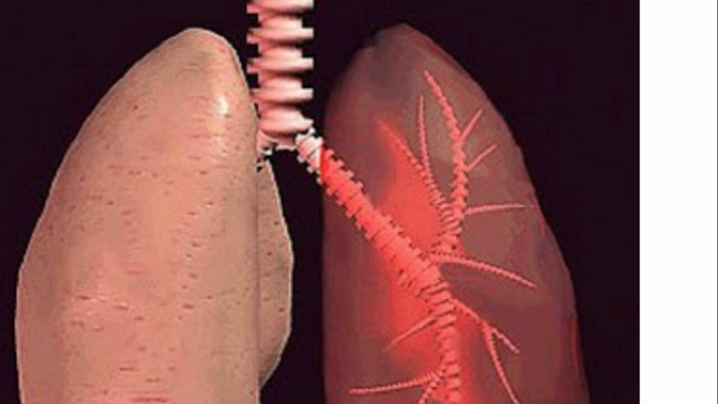 أسباب غير متوقعة للإصابة بسرطان الرئة