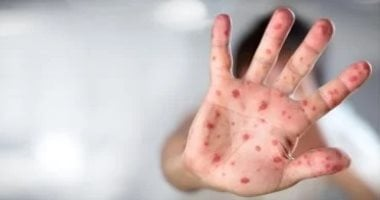 متحور جديد لفيروس جدري القرود في إنجلترا - أفكار جديدة