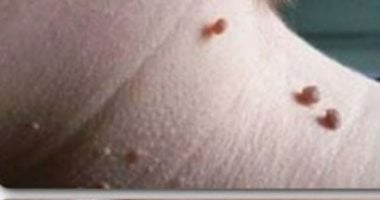 أسباب الزوائد الجلدية وطرق علاجها