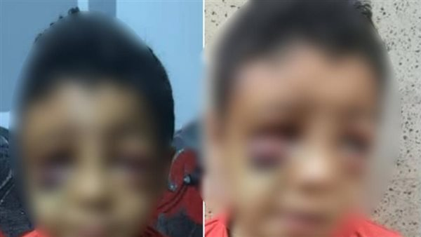 عاجل: منشور مضلل حول إصابة طفل بمدرسة في قنا