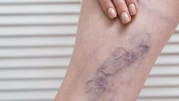 جلطة الساق: تعرف العلامات والأعراض